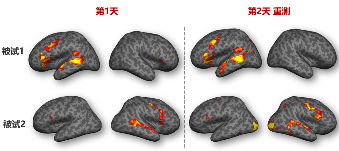 【科普】帕金森病、阿尔茨海默病、抑郁症等患者， 为什么需要一张专属“大脑功能地图”？